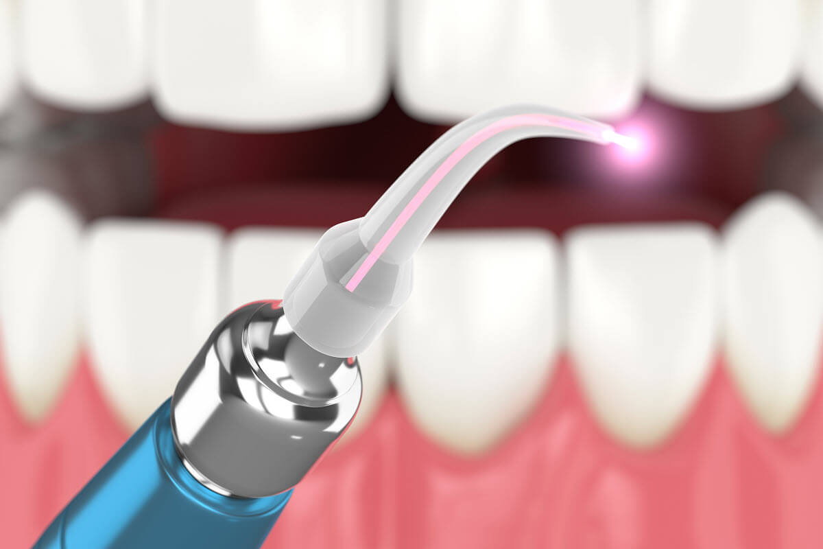 How Lasers Are Transforming Restorative Dentistry - Dentist Orleans / Gloucester - Orleans Gardens Dental Centre How Lasers Are Transforming Restorative Dentistry - Dentist Orleans / Gloucester - Orleans Gardens Dental Centre